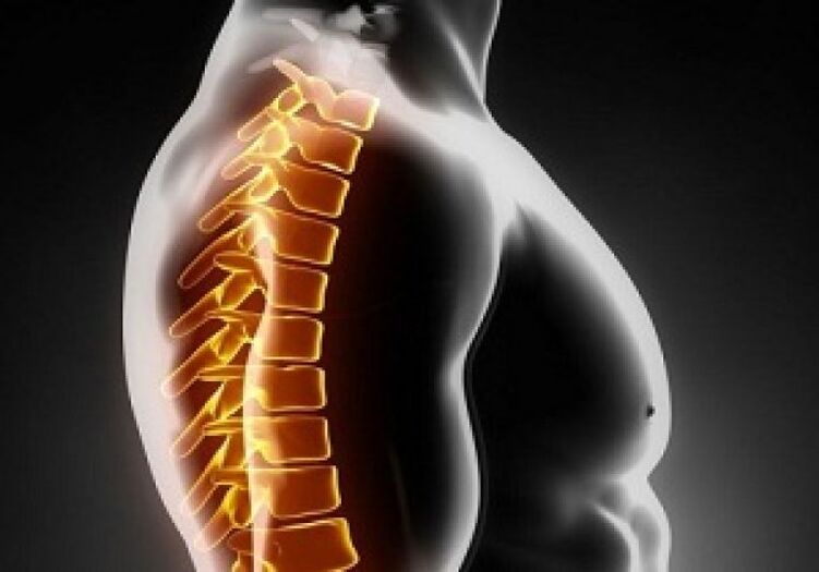 Die thorakale Osteochondrose geht mit Schmerzen und Beschwerden im zentralen Teil des Rückens einher